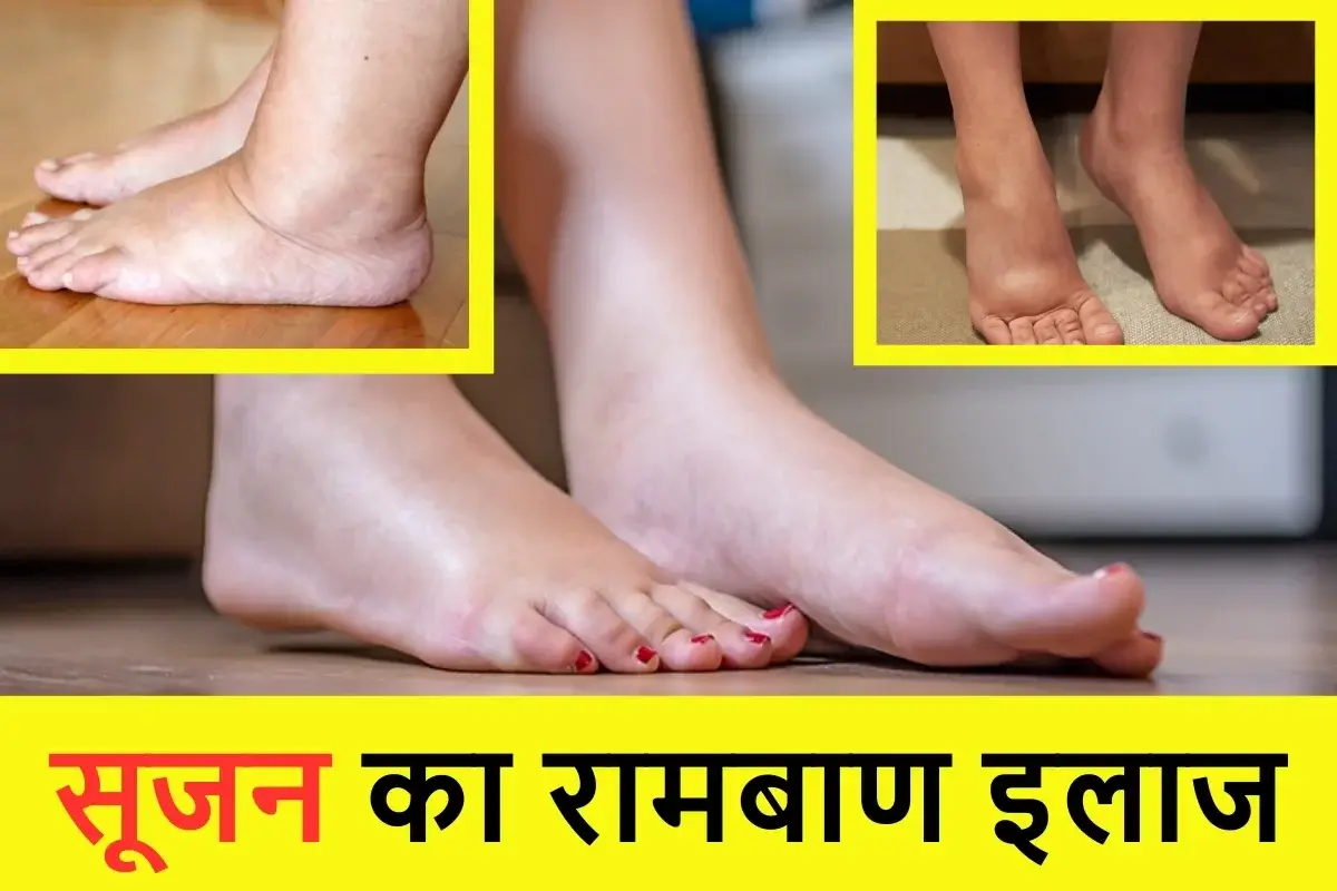 Best Treatment For Swelling Blog Image