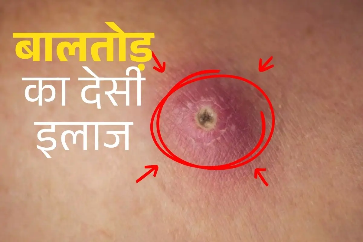 Home Remedies For Boils Blog Image